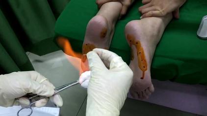 足底筋膜炎针灸图片