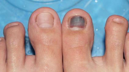 脚指甲黑色素瘤图片图片