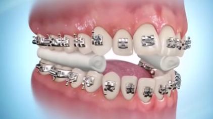 大板牙矫正 西瓜视频