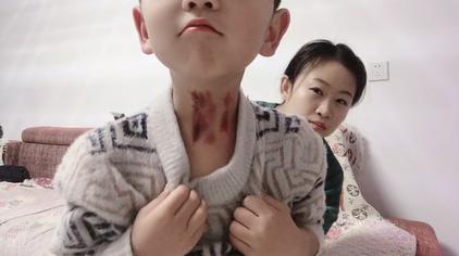 给孩子揪痧视频播放 - 西瓜视频