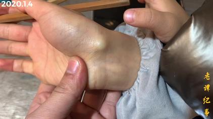 3岁宝宝手腕腱鞘囊肿图片